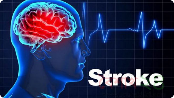 (Stroke)